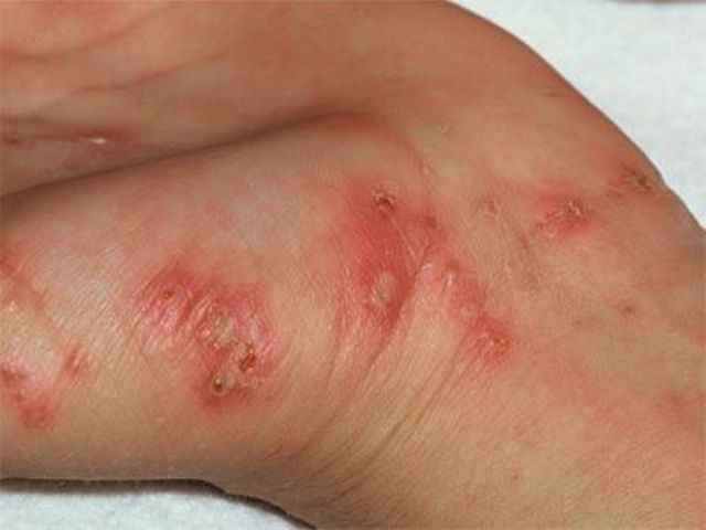 typhus_disease