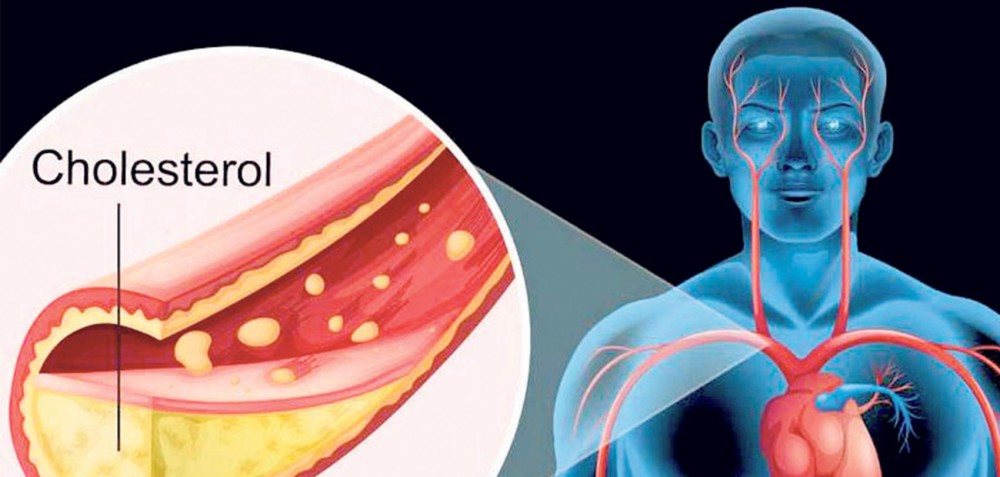 शरीरमा कोलेस्ट्रोल बढ्न नदिन…